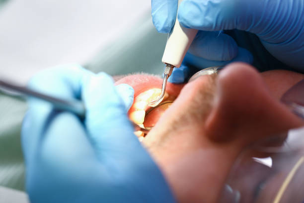 Best Emergency Tooth Extraction in Burnet, TX